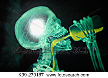 Picture - anatomy, addiction, 
amusing, alcoholism, 
addictions, abuse. 
fotosearch - search 
stock photos, 
pictures, images, 
and photo clipart