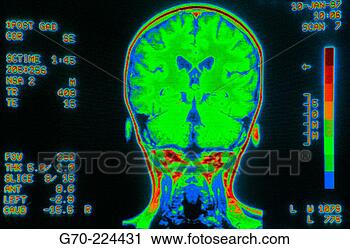 Stock Photography - coloured mri brain 
scan, back view. 
fotosearch - search 
stock photos, 
pictures, images, 
and photo clipart