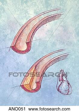 Clipart - hardening of the 
arteries. fotosearch 
- search clipart, 
illustration, 
drawings and vector 
eps graphics images