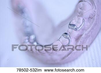 Stock Photo - dental mold. fotosearch 
- search stock 
photos, pictures, 
images, and photo 
clipart