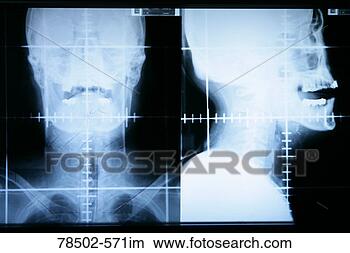 Stock Photo - radiograph of 
human skull. fotosearch 
- search stock 
photos, pictures, 
images, and photo 
clipart