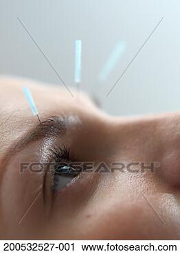 Stock Photography - woman undergoing 
acupuncture treatment, 
close-up. fotosearch 
- search stock 
photos, pictures, 
images, and photo 
clipart