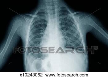 Stock Photo - x-ray image of 
young boy's (12-13) 
torso. fotosearch 
- search stock 
photos, pictures, 
images, and photo 
clipart