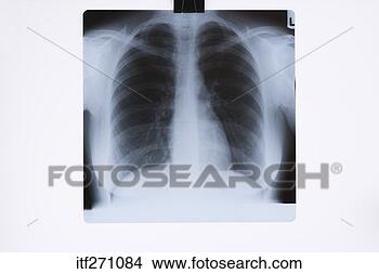 Stock Photo - x-ray of chest. 
fotosearch - search 
stock photos, 
pictures, images, 
and photo clipart