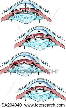 Stock Illustration - four cross-sections 
of eye showing 
increased intraocular 
pressure of. fotosearch 
- search clipart, 
illustration, 
drawings and vector 
eps graphics images