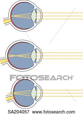 Stock Illustration - three images of 
the mechanics 
of sight;  (top) 
normal,  (middle) 
near. fotosearch 
- search clipart, 
illustration, 
drawings and vector 
eps graphics images