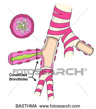 Arquivos de Ilustração - bronchial,  asma. 
fotosearch - busca 
de ilustrações 
clipeart e desenhos