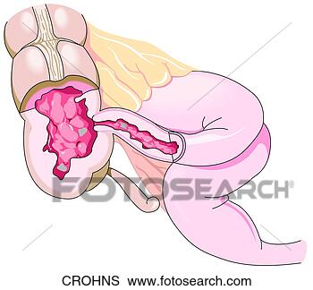 Stock Illustration - crohn's disease. 
fotosearch - search 
clipart, illustration, 
drawings and vector 
eps graphics images