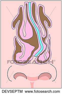 Stock Illustration - deviated nasal 
septum. fotosearch 
- search clipart, 
illustration, 
drawings and vector 
eps graphics images