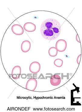 Clipart - ferro,  deficiência, 
 anemia. fotosearch 
- busca de ilustrações 
clipeart e desenhos