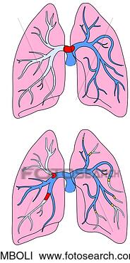 Stock Illustration - pulmonary emboli. 
fotosearch - search 
clipart, illustration, 
drawings and vector 
eps graphics images