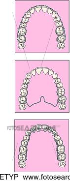 Arquivos de Ilustração - bracetyp, bracetyp. 
fotosearch - busca 
de ilustrações 
clipeart e desenhos