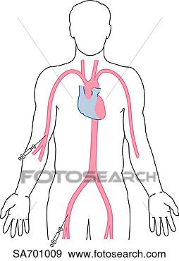 Stock Illustration - image shows two 
typical entry 
points,  popliteal 
and femoral,  
when. fotosearch 
- search clipart, 
illustration, 
drawings and vector 
eps graphics images