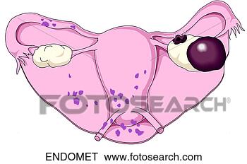 icd 9 code for a nodule in the endometrium