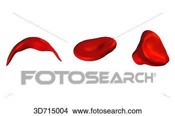 Stock Illustration - red blood cells 
of irregular shape: 
drepanocyte (sickle 
cell) (left). 
fotosearch - search 
clipart, illustration, 
drawings and vector 
eps graphics images