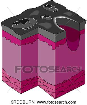 Arquivos de Ilustração - terceiro,  grau, 
 queimadura. fotosearch 
- busca de ilustrações 
clipeart e desenhos