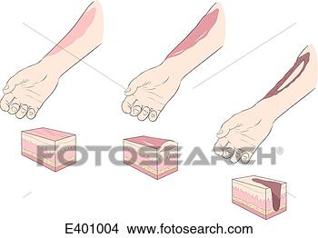 Stock Illustration - burns, types. 
fotosearch - search 
clipart, illustration, 
drawings and vector 
eps graphics images