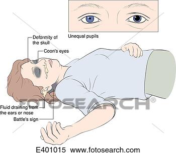 Stock Illustration - signs of head 
injury. fotosearch 
- search clipart, 
illustration, 
drawings and vector 
eps graphics images