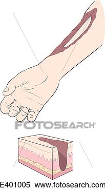 Hazır İlüstrasyonlar - yanıklar,  türler, 
 (full-thickness). 
fotosearch - klipart 
İlüstrasyon, çizimler 
ve görüntüler 
ara