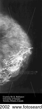 Clip Art - galactogram of 
breast  contrast 
has been injected 
into a lactiferous. 
fotosearch - search 
clipart, illustration, 
drawings and vector 
eps graphics images