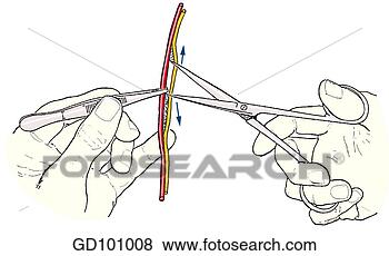 Stock Illustration - scissors technique: 
separating delicate 
structures. fotosearch 
- search clipart, 
illustration, 
drawings and vector 
eps graphics images