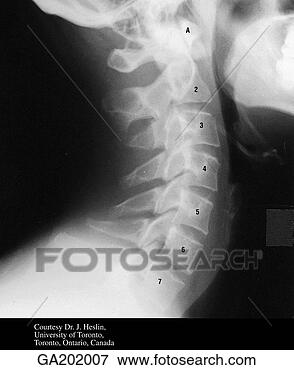 Stock Illustration - lateral radiograph 
of the cervical 
vertebrae, showing 
the atlas. fotosearch 
- search clipart, 
illustration, 
drawings and vector 
eps graphics images