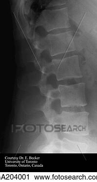 Clipart - lateral radiograph 
of the lumbar 
vertebrae. fotosearch 
- search clipart, 
illustration, 
drawings and vector 
eps graphics images