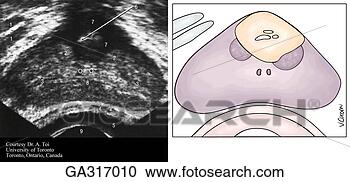 Stock Illustration - axial (transverse) 
transrectal ultrasound 
scans through 
prostate a. fotosearch 
- search clipart, 
illustration, 
drawings and vector 
eps graphics images