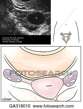 Stock Illustration - ultrasound scans 
of female pelvis 
b transvaginal 
sagittal scan 
on. fotosearch 
- search clipart, 
illustration, 
drawings and vector 
eps graphics images