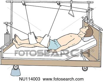 Drawing - balanced suspension 
traction using 
slings  male patient 
in hospital. fotosearch 
- search clipart, 
illustration, 
drawings and vector 
eps graphics images