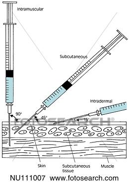 Stock Illustration - simple drawing 
of cross section 
of skin with three 
needles. fotosearch 
- search clipart, 
illustration, 
drawings and vector 
eps graphics images