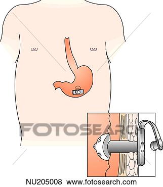 Stock Illustration - internal placement 
of gastrostomy 
button in a child 
 insert shows 
how. fotosearch 
- search clipart, 
illustration, 
drawings and vector 
eps graphics images