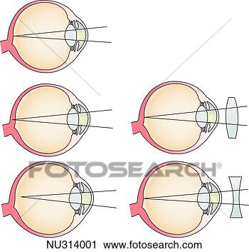 Clipart - illustration demonstrating 
how corrective 
lenses aid in 
seeing (top). 
fotosearch - search 
clipart, illustration, 
drawings and vector 
eps graphics images