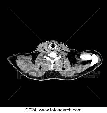 Hazır İlüstrasyonlar - thorax. fotosearch 
- klipart İlüstrasyon, 
çizimler ve görüntüler 
ara