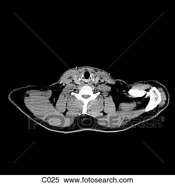 Hazır İlüstrasyonlar - thorax. fotosearch 
- klipart İlüstrasyon, 
çizimler ve görüntüler 
ara