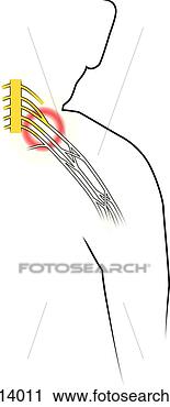 Clipart - anatomia,   braquial, 
  plexus,   região, 
  mostrando,  
 dano. fotosearch 
- busca de ilustrações 
clipeart e desenhos