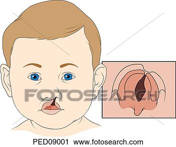 Clipart - anterior view 
of child's face 
showing a cleft 
of the upper lip 
that. fotosearch 
- search clipart, 
illustration, 
drawings and vector 
eps graphics images