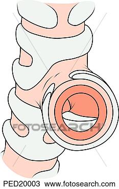 Drawing - blow up and cutaway 
of a bronchus; 
note swelling 
and inflammation 
of. fotosearch 
- search clipart, 
illustration, 
drawings and vector 
eps graphics images