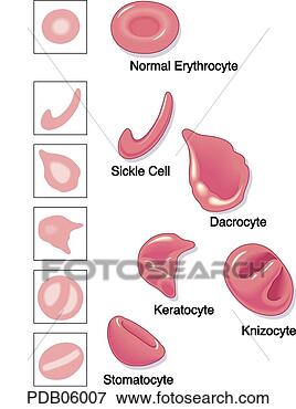 Stock Illustration - chart showing 
abnormal red blood 
cells. fotosearch 
- search clipart, 
illustration, 
drawings and vector 
eps graphics images