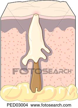 Stock Illustration - cross-section 
of hair follicle 
and sebaceous 
gland of the skin. 
fotosearch - search 
clipart, illustration, 
drawings and vector 
eps graphics images
