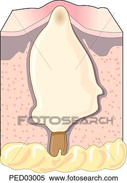 Stock Illustration - cross-section 
of hair follicle 
and sebaceous 
gland of the skin. 
fotosearch - search 
clipart, illustration, 
drawings and vector 
eps graphics images