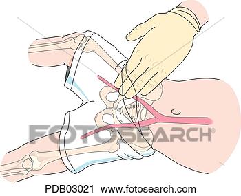 femoral pulse