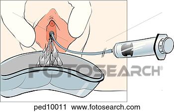 ajora, 是, 分开, 对于, 允许, 显现, 在中, <em>处女膜</em>, 