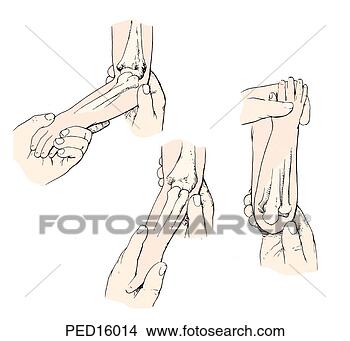 radial head subluxation reduction