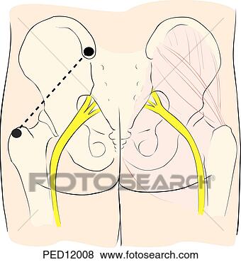 intramuscular injection sites painting