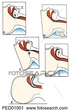 Clipart - (top l)  upper 
airway obstruction 
related to hypotonia; 
 (top r). fotosearch 
- search clipart, 
illustration, 
drawings and vector 
eps graphics images