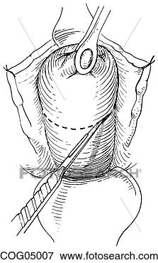 Stock Illustration - cervical cerclage, 
shirodkar-barter 
techn, part 3. 
fotosearch - search 
clipart, illustration, 
drawings and vector 
eps graphics images