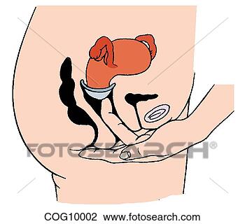 female inserting a diaphragm