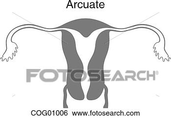 Arquivos de Ilustração - mullerian,  tubo, 
 anomalia,  arcuate. 
fotosearch - busca 
de ilustrações 
clipeart e desenhos