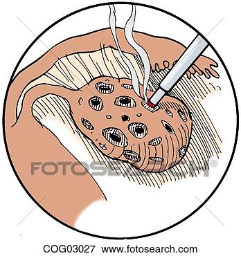 EPS ابلیشن